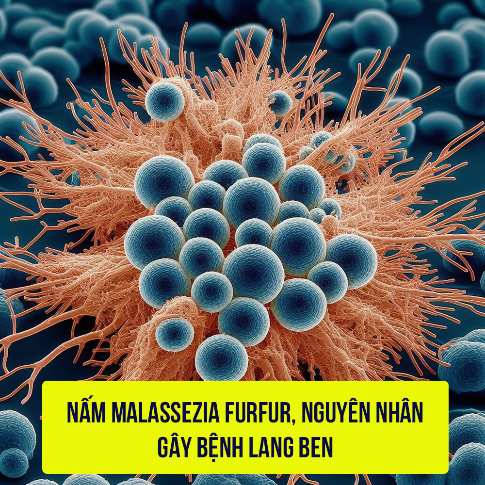 Bệnh lang ben do nấm Malassezia furfur gây nên. Bệnh lây nhiễm từ người này sang người khác trực tiếp hoặc gián tiếp qua khăn lau, giường chiếu