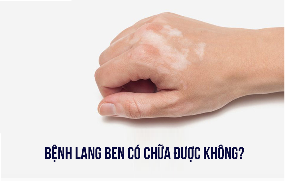 Tự chữa bệnh lang tại nhà ben an toàn, hiệu quả