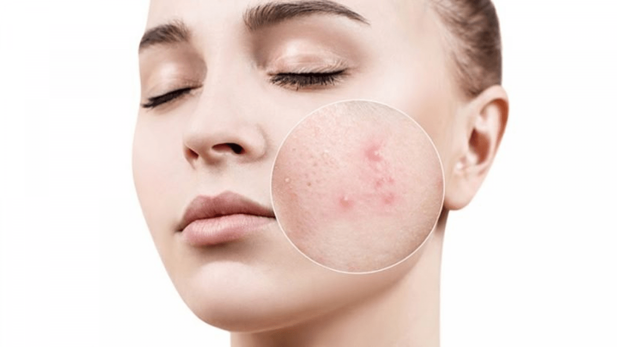 Cách trị mụn trứng cá đơn giản và nhanh nhất