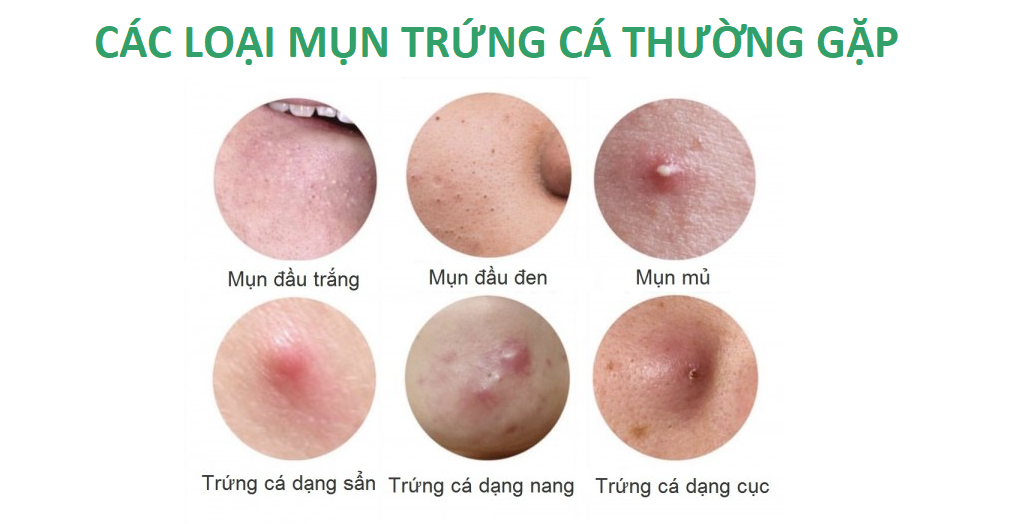 Cách trị mụn trứng cá đơn giản và nhanh nhất